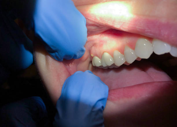 Best Emergency Dentist for Lost Fillings or Crowns in Ashburn, VA