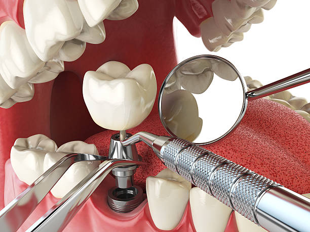Best Emergency Dental Extractions in Ashburn, VA